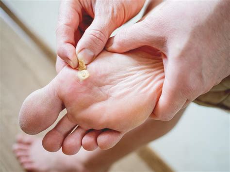 What Causes Warts and How to Get Rid of Them: Dermatology Associates of ...