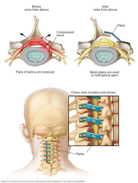 Laminoplasty in 2020 (With images) | Spinal stenosis, Stenosis, Spinal