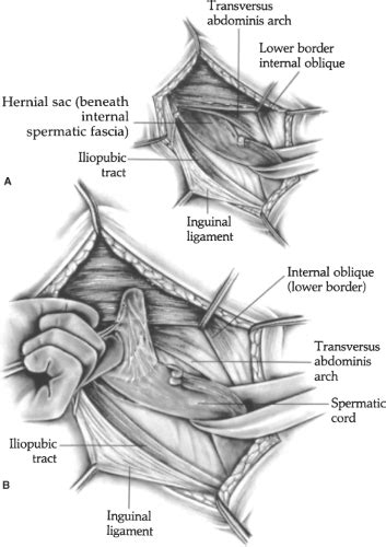 Iliopubic Tract Repair of Inguinal Hernia: the Anterior (Inguinal Canal ...