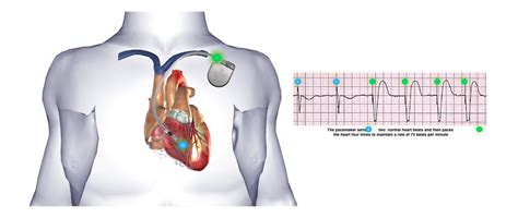 Implantable Cardioverter Defibrillator (ICD) - One Heart Cardiology