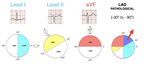 Positiver QRS Komplex in aVR und aFV | Expertenrat Herz- und ...