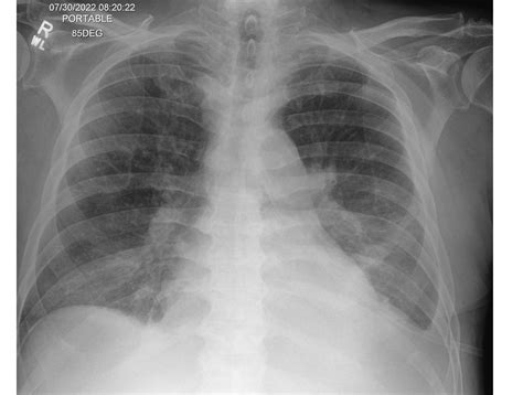 Case 211: Stages of Cardiogenic Pulmonary Edema — DartRad