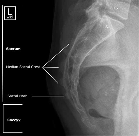 Sacrum Radiographic Anatomy - wikiRadiography | Radiology, Diagnostic ...