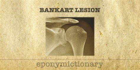 Bankart Lesion • LITFL • Medical Eponym Library