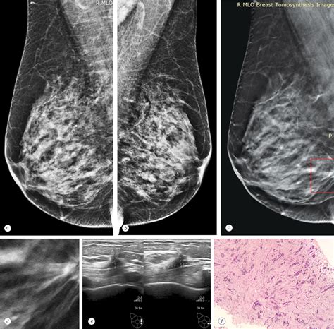 Detection of breast cancer presenting as a mass in women with dense ...