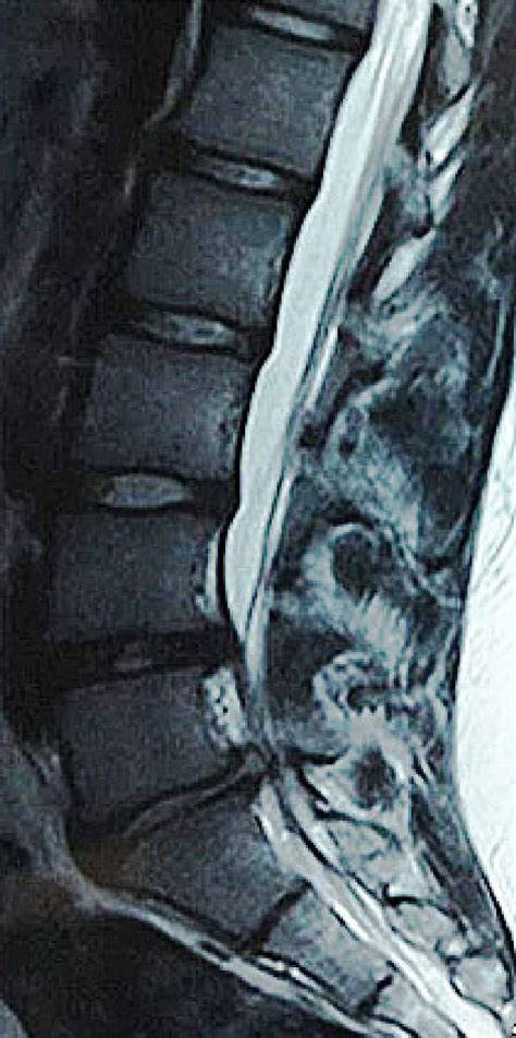 T2-weighted sagittal MRI image, disc herniation in L4-L5 and L5-S1 ...