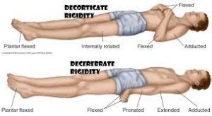 Abnormal Posturing. Decorticate and Decerebrate Rigidity - HealthnPhysio