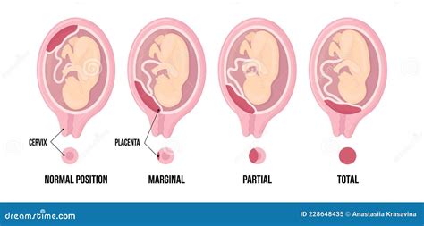 Normal Placental Previa. Usual Anatomical Placenta Location During ...