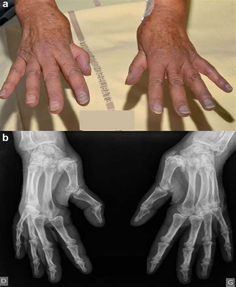 Jaccoud’s arthropathy causes, symptoms, diagnosis & treatment