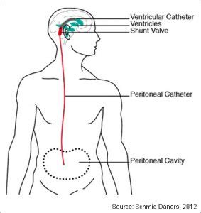 Ventriculoperitonial Shunt | Adult Hydrocephalus Center