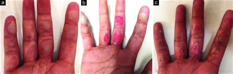 (a) Burn blisters at presentation (b) Deroofing of the burn blister ...