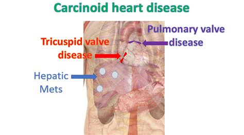 Carcinoid heart disease – All About Cardiovascular System and Disorders