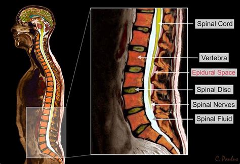 Lumbar Spine MRI | Mri Scan Images