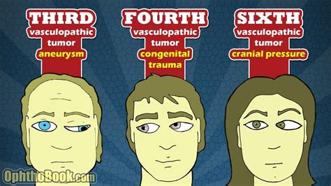 Third and fourth and sixth cranial nerve palsy. .. | Cranial nerves ...