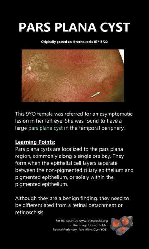 Vitreous, Vitreoretinal Interface Abnormalities, and Peripheral Retina ...