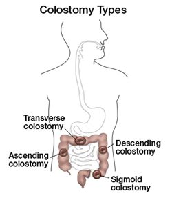 Colostomy Diagram