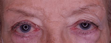 Palpebral ptosis or drooping eyelid. What is it? | ICR