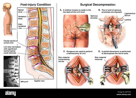 Lumbar Disc Herniation L4-5 with Surgical Laminectomy and Discectomy ...