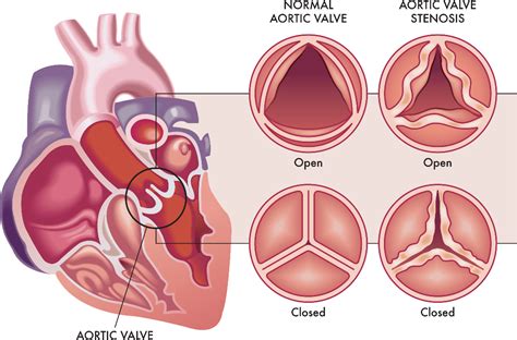 What are Aortic Stenosis Symptoms and Causes? | Dr. C Raghu