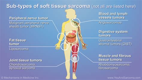 Understanding Soft Tissue Sarcoma