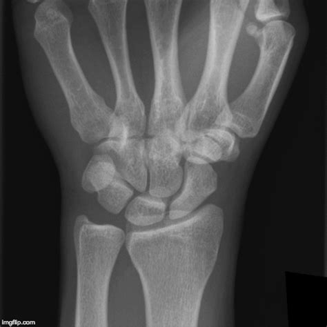 Xray Of Hand Bones