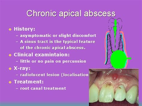 Periradicular Periapical Diseases Introduction u Periradicular tissues ...