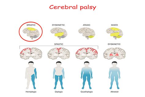 Cerebral palsy – Symptoms, and Causes