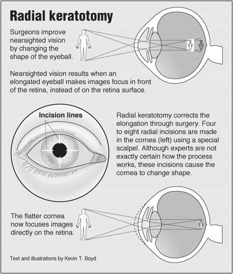 Radial keratotomy – PointFinder Health Infographics