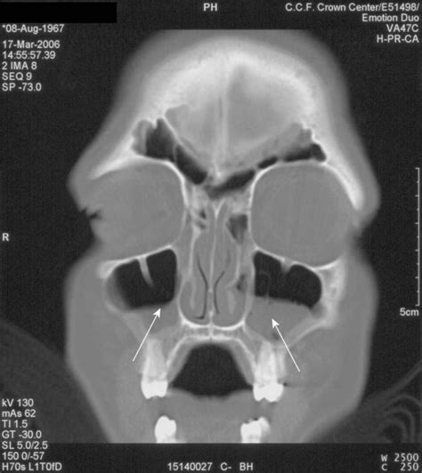 Acute Sinusitis X Ray