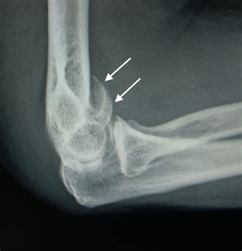 Treatment of Distal Humerus Fractures - Cancer Therapy Advisor