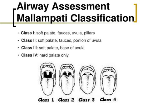 Modified Mallampati Classification