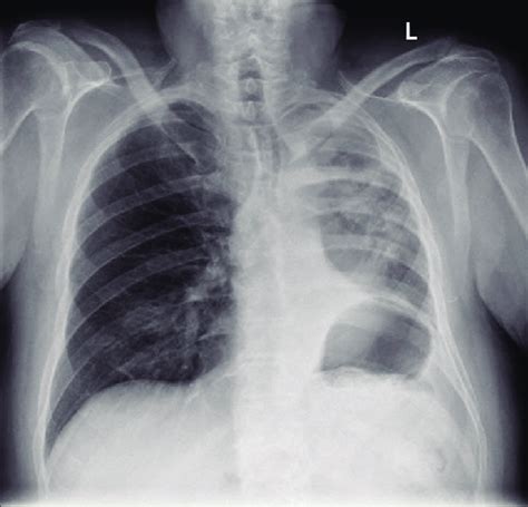 How To Read A Chest X-ray [Step-by-Step] - TheMDJourney