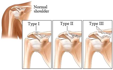 Acromioclavicular Joint Separation Treatment