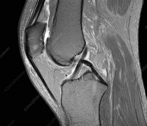 What Does A Normal Knee Mri Look Like