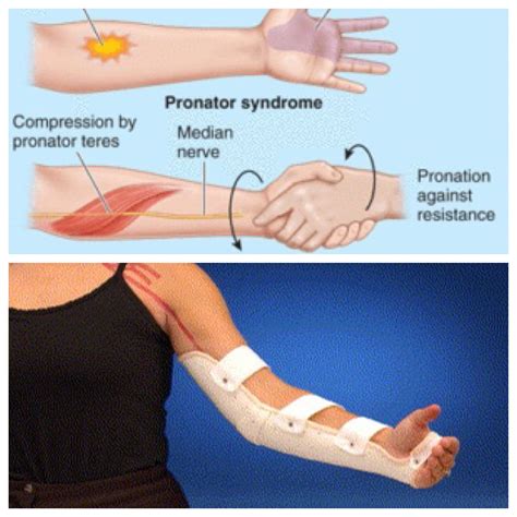 Pin on ulnar nerve