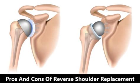 Pros and Cons of Reverse Shoulder Replacement » Advantages & Disadvantages