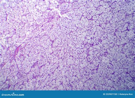 Adrenocortical Adenoma, Light Micrograph Royalty-Free Stock Image ...