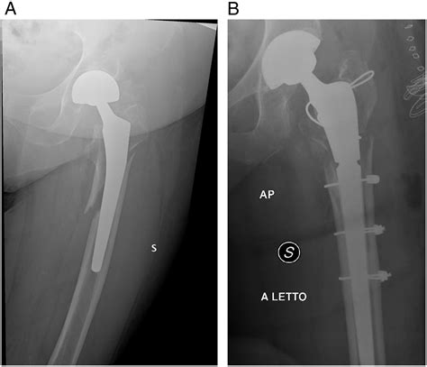 Treatment Algorithm of Periprosthetic Femoral Fracturens - Nicola ...