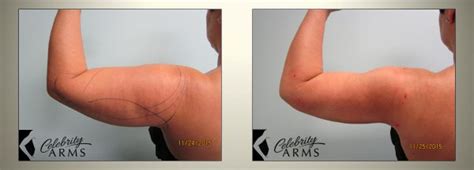 Arm Liposuction Before and After Results Large