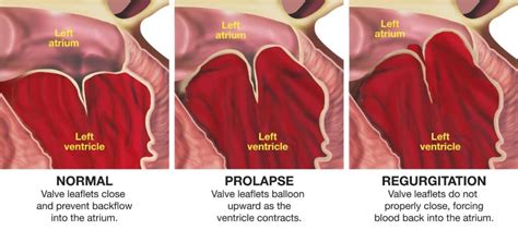 Mitral valve prolapse | Child Heart Specialist - Paediatric Cardiologist