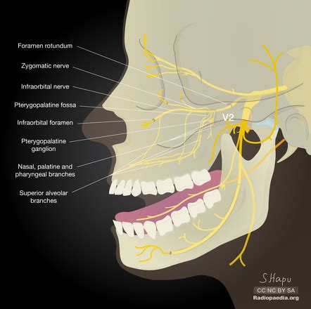 Infraorbital nerve | Radiology Reference Article | Radiopaedia.org