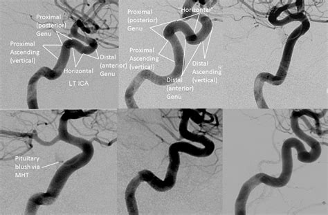 Internal Carotid Artery and Its Aneurysms | neuroangio.org