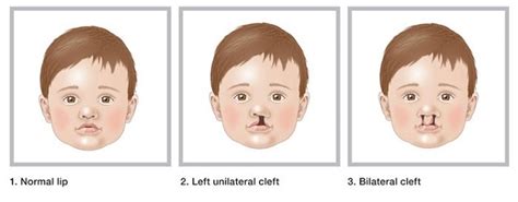 Kids Health Information : Cleft lip and cleft palate