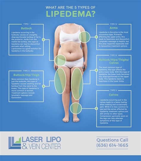 Image result for lipoedema compression | Lipedema treatment, Lipedema ...