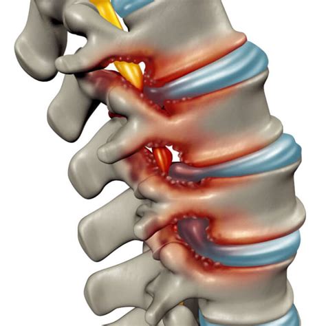 Spondylose (Wirbelsäulen-Verschleiß) | Liebscher & Bracht