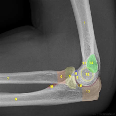 Normal radiographic anatomy of the elbow | Radiology Case | Radiopaedia ...