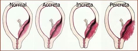 Placenta Previa — Taming the SRU