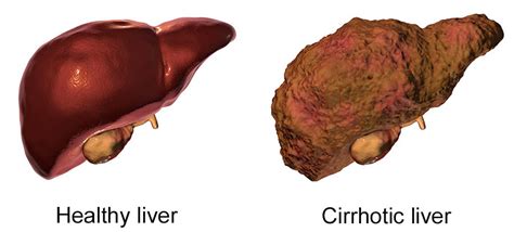 Cirrhosis of the liver | healthdirect