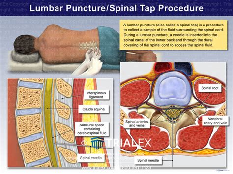 Lumbar Puncture/Spinal Tap Procedure - TrialQuest Inc.