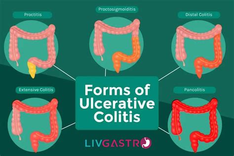 Ultimate Guide To Colitis Types Causes Symptoms Treatment | The Best ...